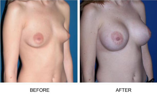 , Breast Implants