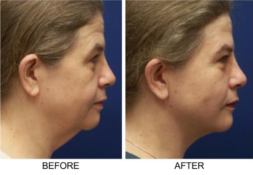 , One Hour SMART Facelift