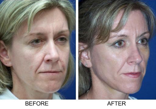 , One Hour SMART Facelift