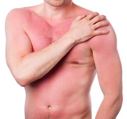 If you’re currently dealing with sunburn or want to prepare for the future, consider these tips for treating the burn and discomfort.