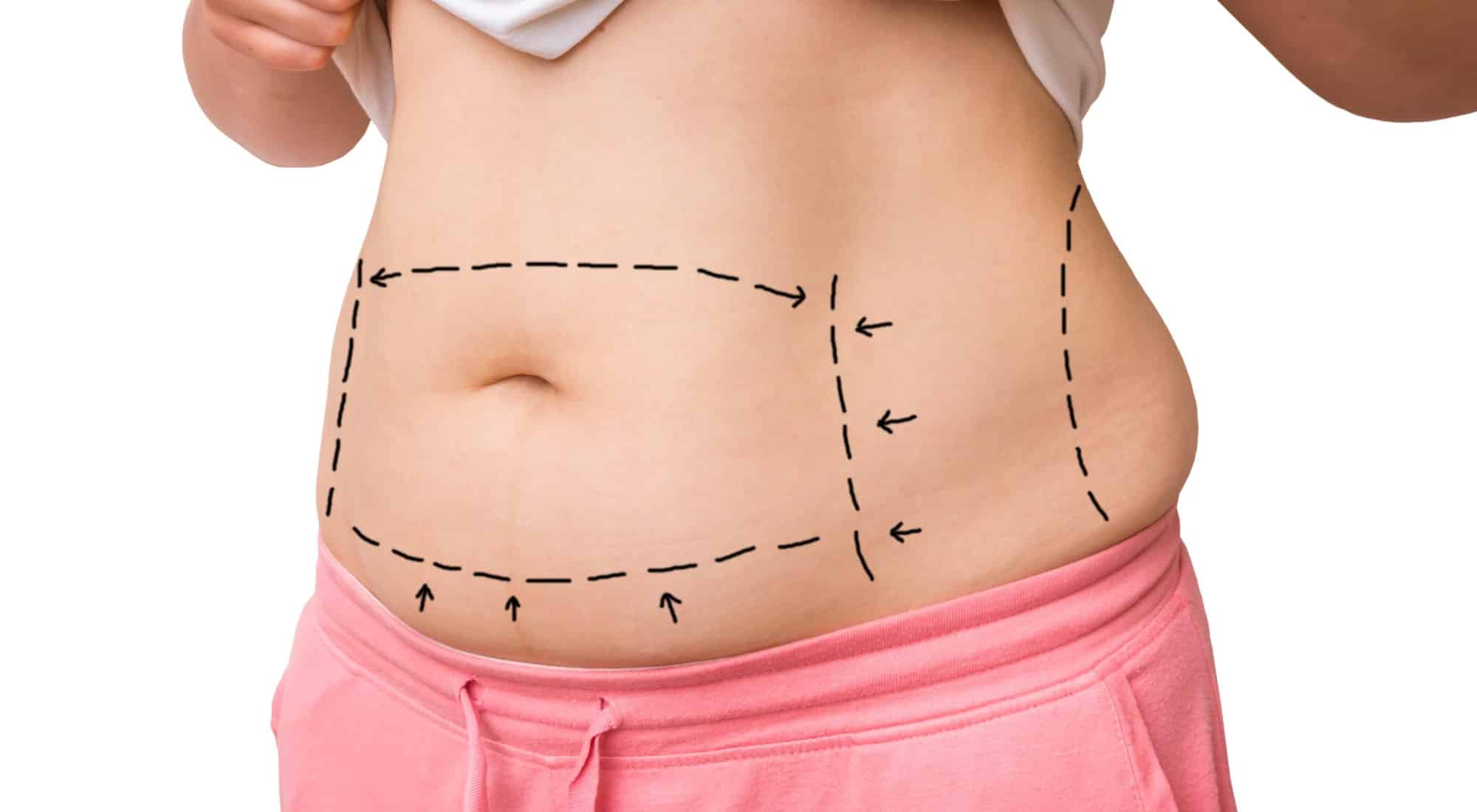 Liposuction vs Tummy Tuck: The Differences