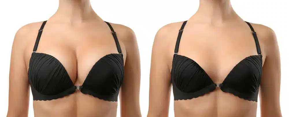 Breast Lift | Maryland Plastic Surgery and PURE MedSpa