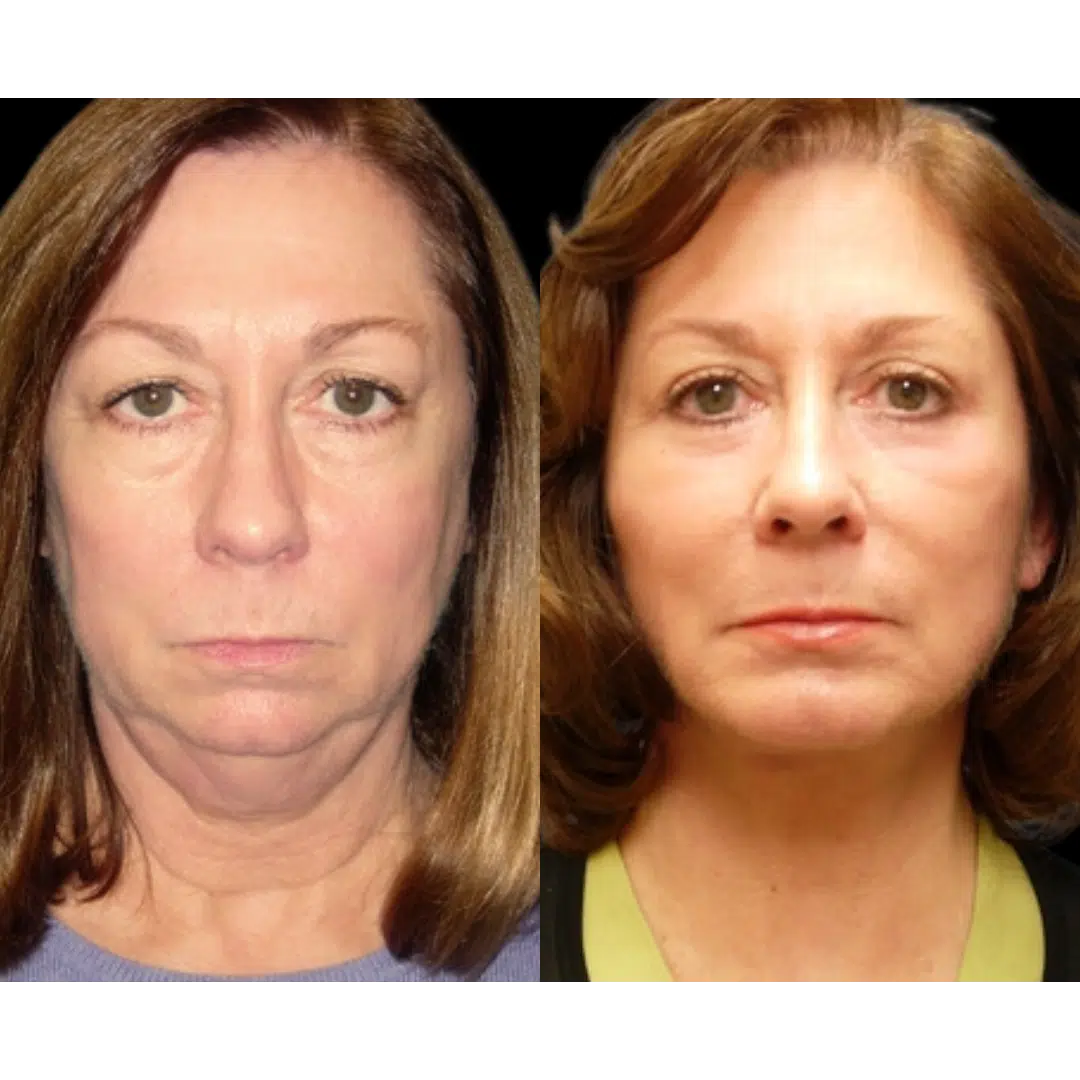 are b12 lipotropic injections safe Considering Lipo B12? Find Out If You're a Good Candidate