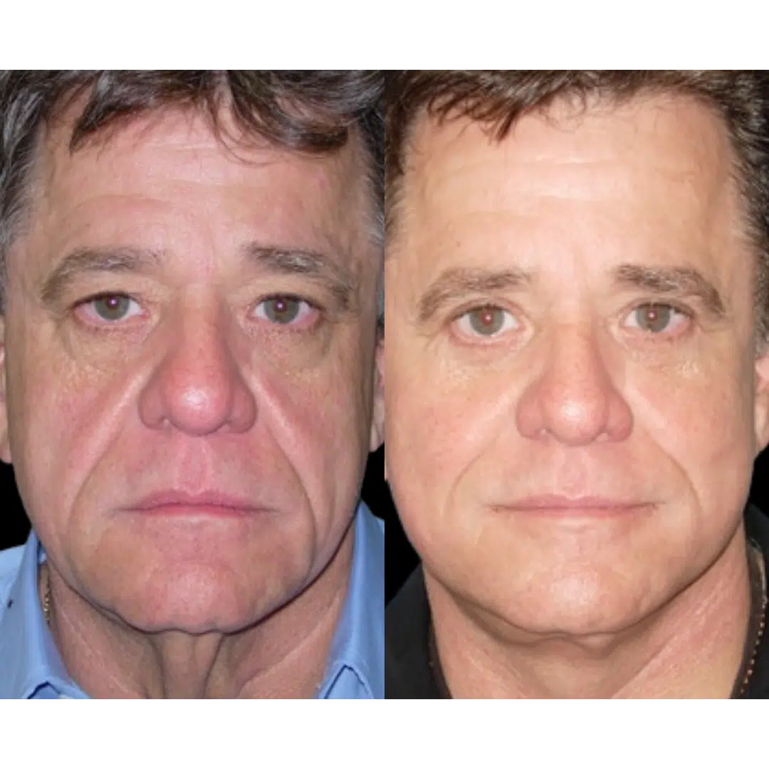 RF Skin Tightening - Maryland Plastic Surgery