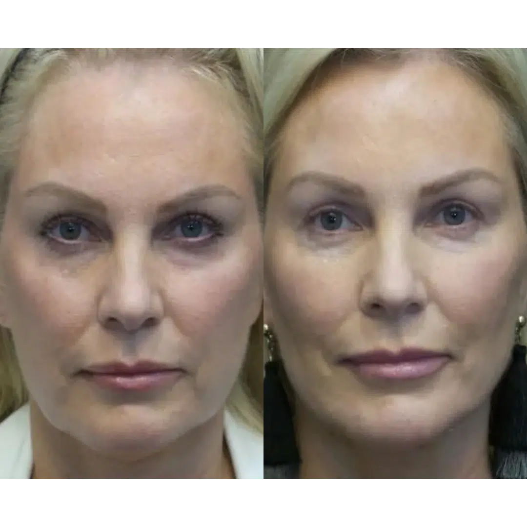 vitamin b12 injections before and after B12 Injections