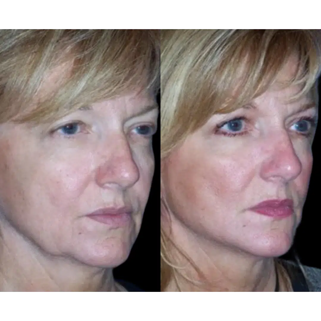 RF Skin Tightening - Maryland Plastic Surgery