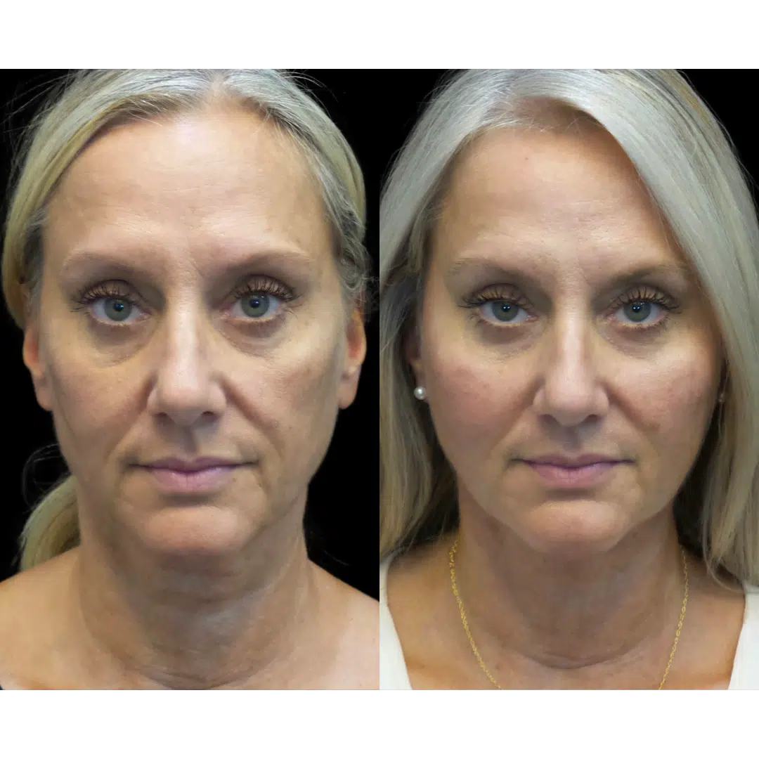 RF Skin Tightening - Maryland Plastic Surgery