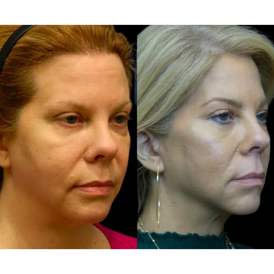 Facelift in Millersville, MD Maryland Plastic Surgery
