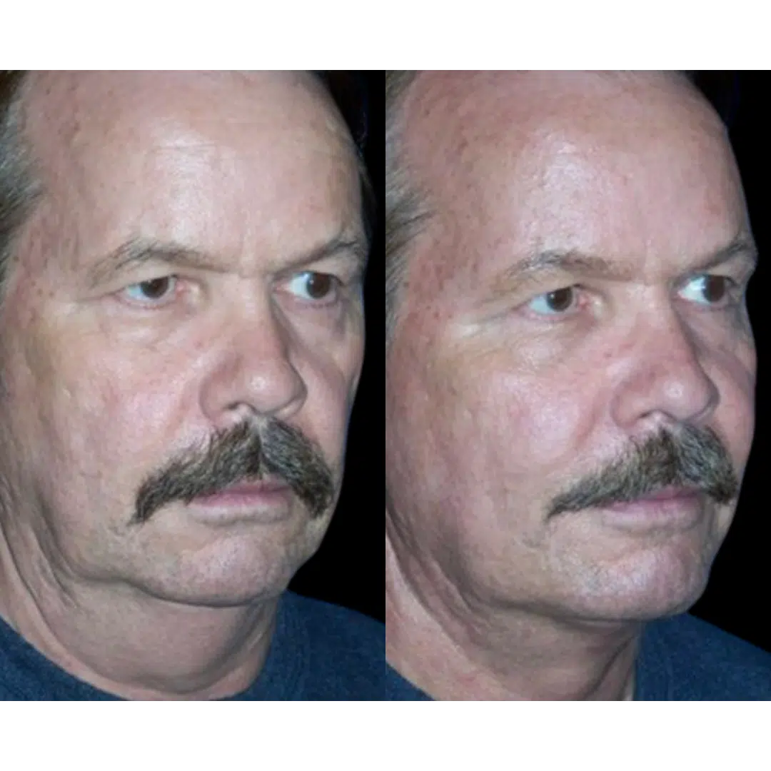 B12 Injections